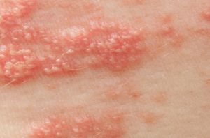 대상 포진 사진
