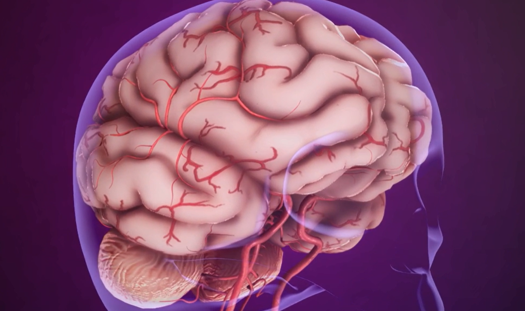 모야모야병 증상