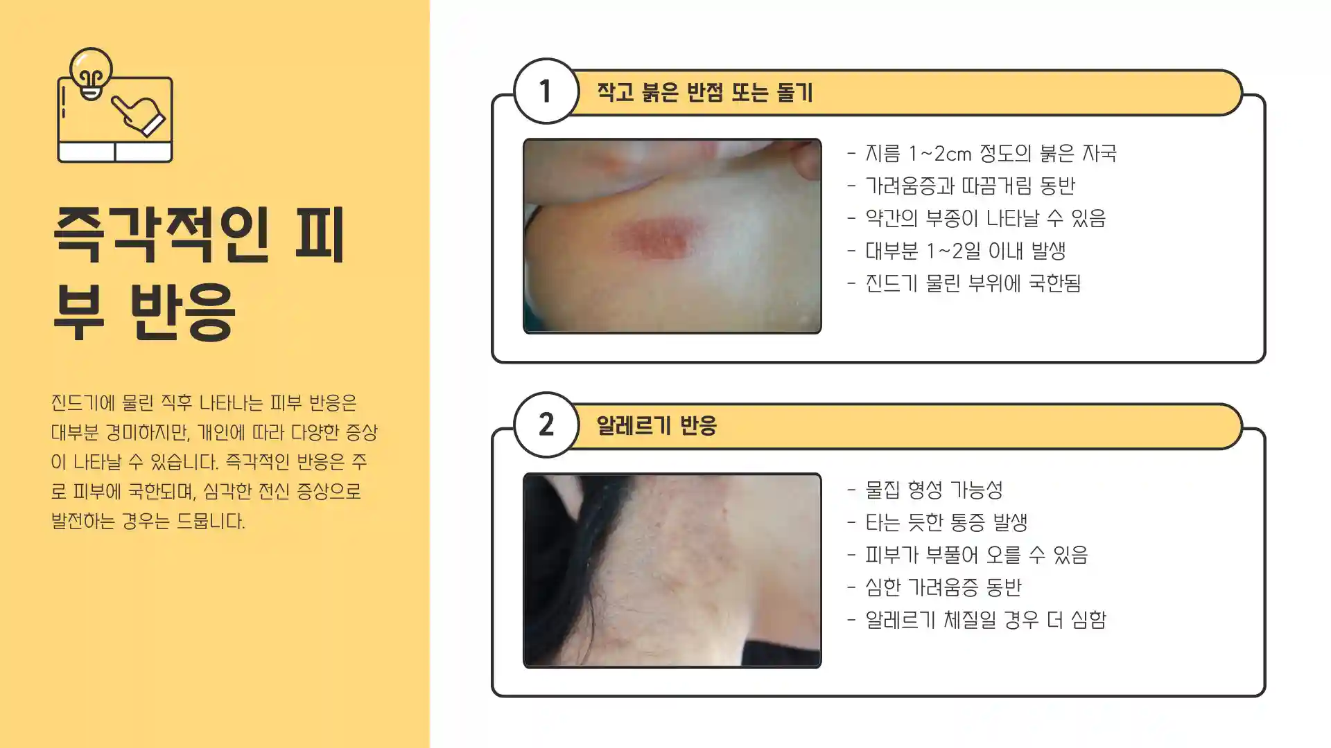 진드기 물린 후 증상