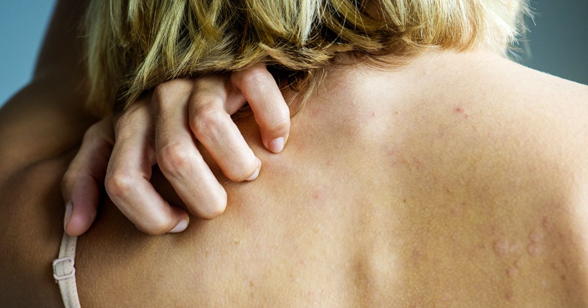 대상포진 예방접종 가격 (+ 최저가&amp;#44; 무료접종)