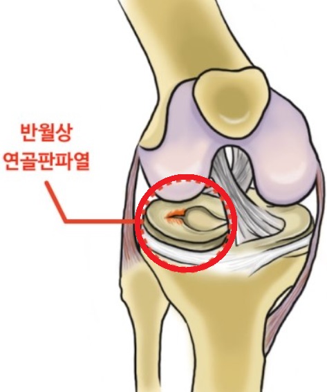 반월상-연골판파열