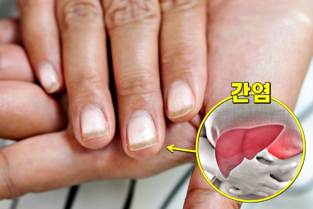 간염 증상 손톱으로 보는 건강상태, 건강 팁줌 매일꿀정보