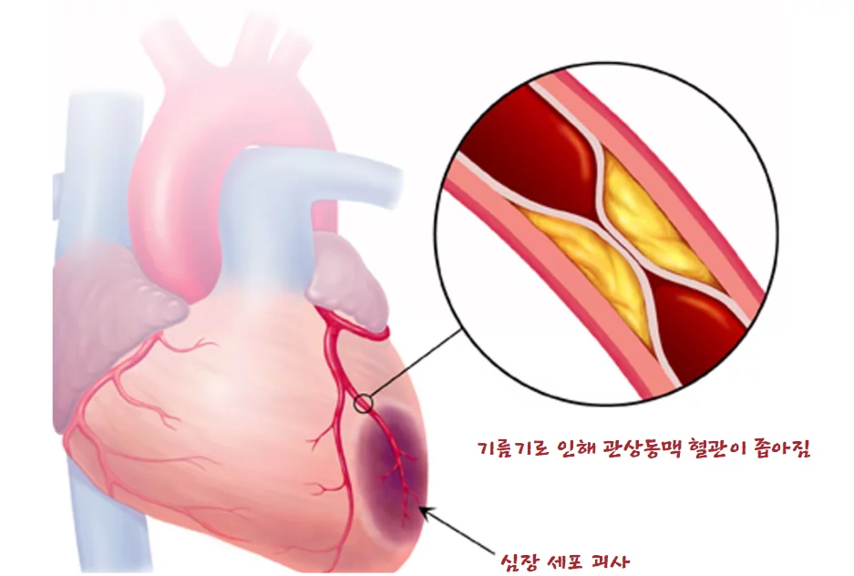 심근경색-원인
