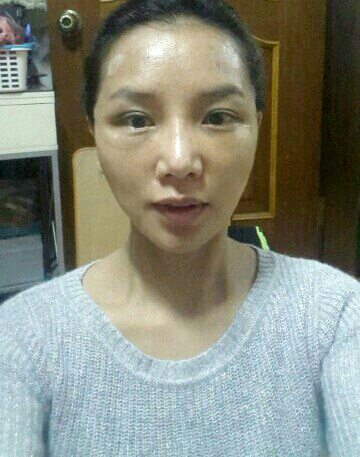 상안검 수술 후기