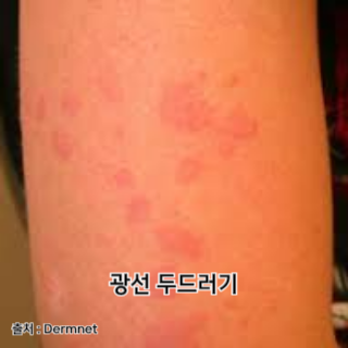 햇빛-알레르기-증상