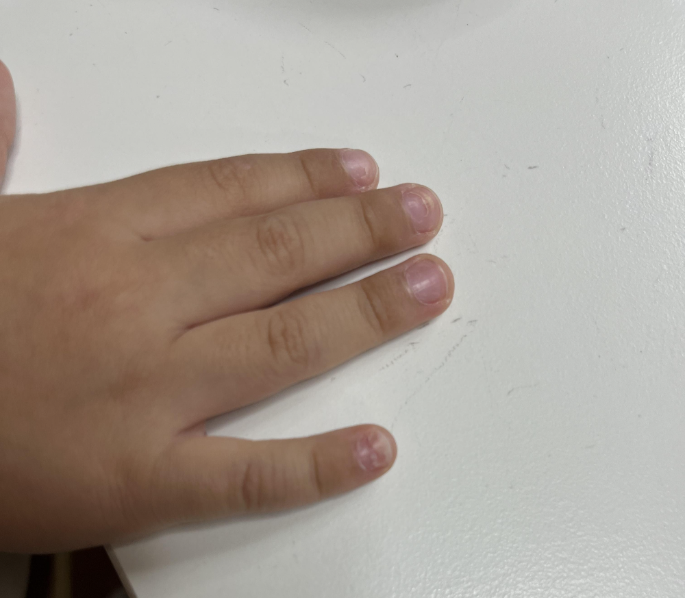 아기-손톱빠짐-수족구-후유증