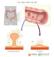 용종과 선종의 차이