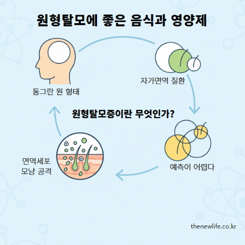 원형탈모증이란 무엇인가를 설명하는 인포그래픽 – 자가면역 질환으로 인해 면역세포가 모낭을 공격해 동그란 원 형태의 탈모가 생기고, 예측이 어려운 특징을 시각적으로 표현한 이미지