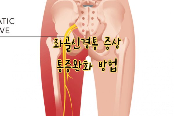 좌골신경통 증상 통증완화 방법