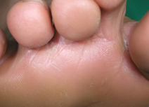 무좀 증상별 무좀약 추천