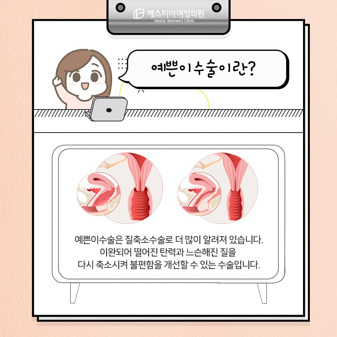 이쁜이수술이란?