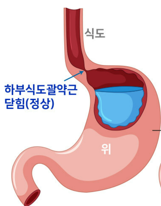 역류성 식도염 증상