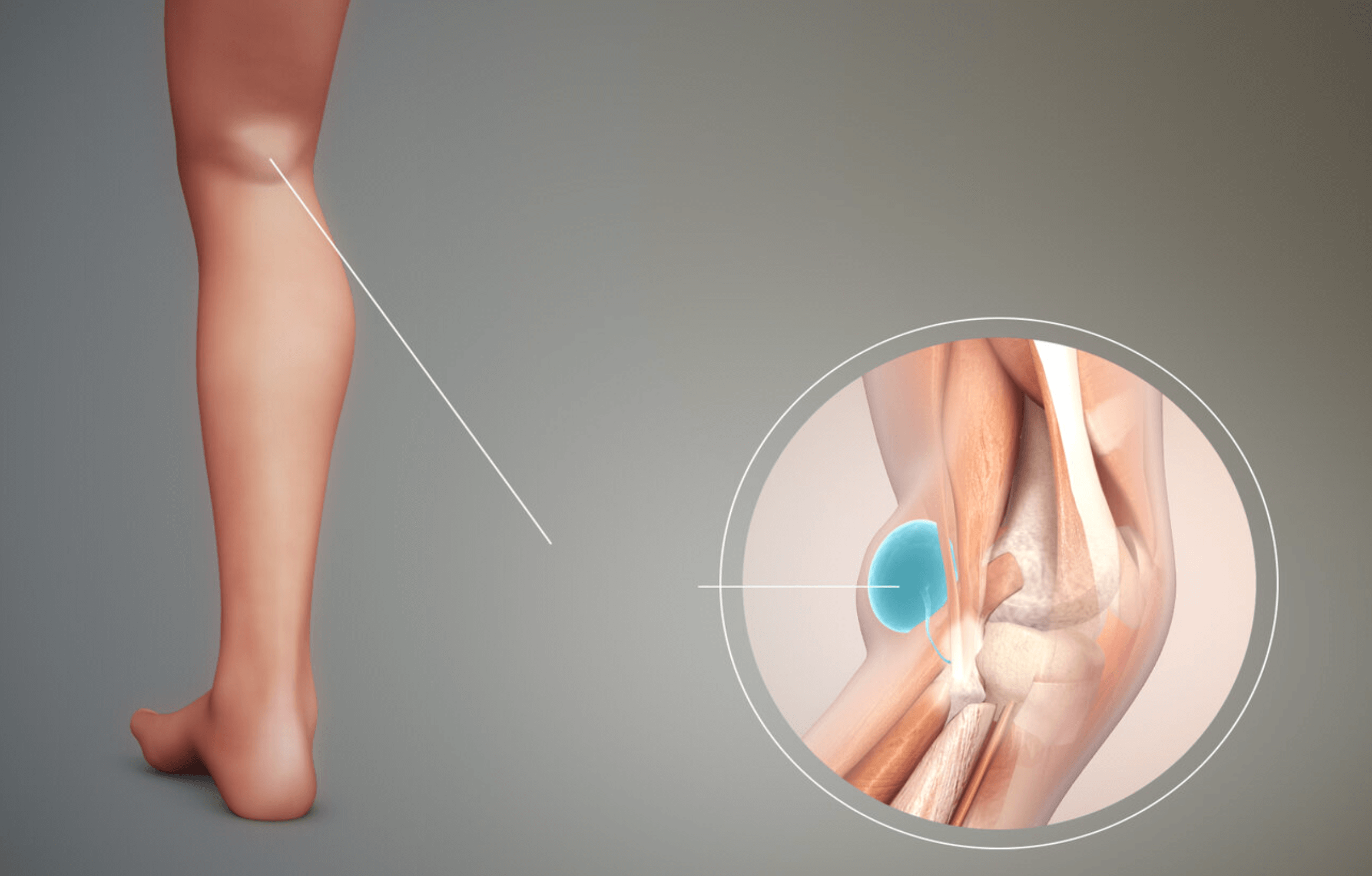 베[이커 낭종 원인