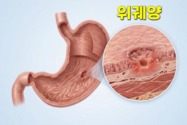 위궤양 증상