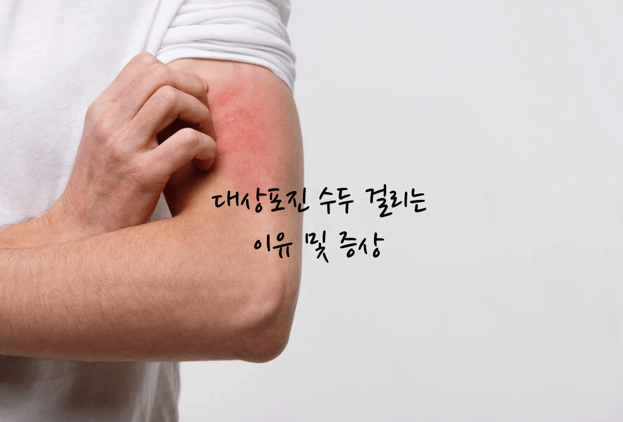 대상포진 수두