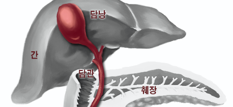 담낭 용종2