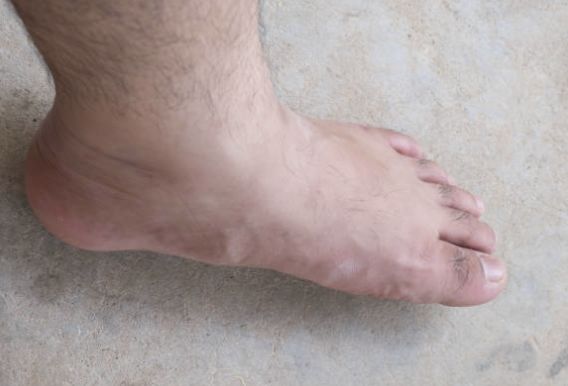 발등이 아픈 이유