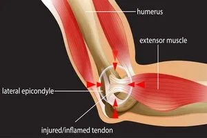 팔꿈치-바깥쪽-통증