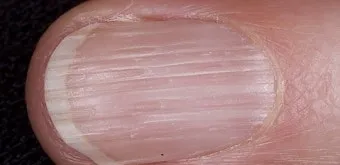 손톱이 갈라지는 이유 원인 증상 대처법_33