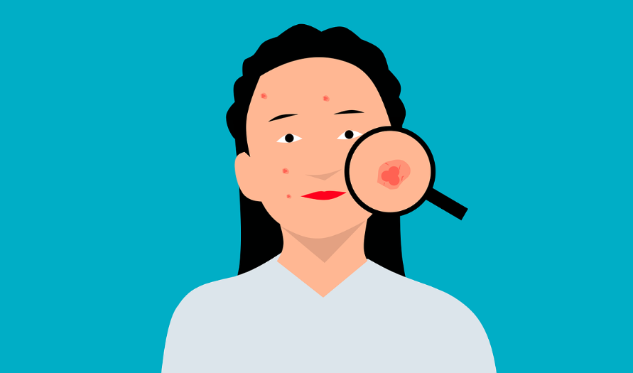 2025년 최신 여드름연고 추천 완벽 가이드 ❘ 약국 여드름 치료제 총정리