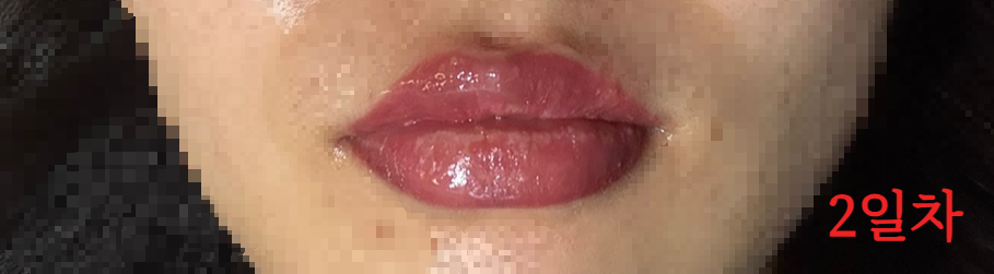 립타투 2일차 – 붓기와 따끔거림이 느껴지는 입술 상태