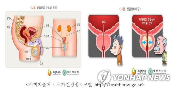 전립선비대증 증상과 치료방법 총정리