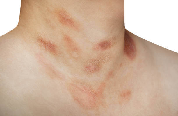 장미색 비강진 원인, 치료, 재발 등에 대해 알아봤습니다. 장미색 비강진은 pityriasis rosea이라고 불리는데요. 어떤 증상과 원인 치료가 있는지 꼼꼼히 읽어보세요!