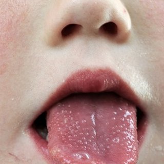 성홍열 증상, 원인, 치료