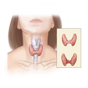 목 안의 갑상선을 투시한 이미지