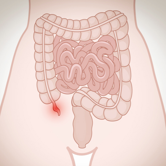 충수의 위치와 충수염