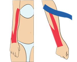테니스 엘보우 (팔꿈치 외측 통증)