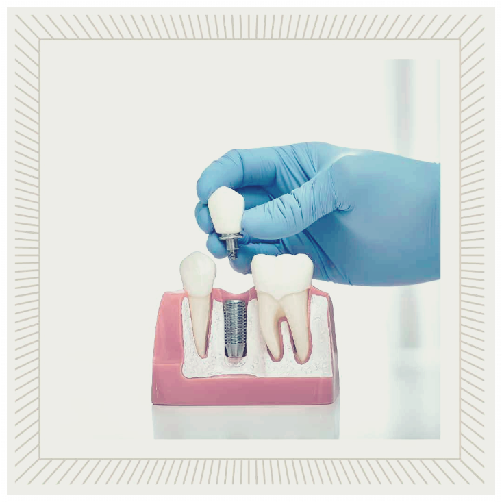 치과 임플란트 건강보험적용가격