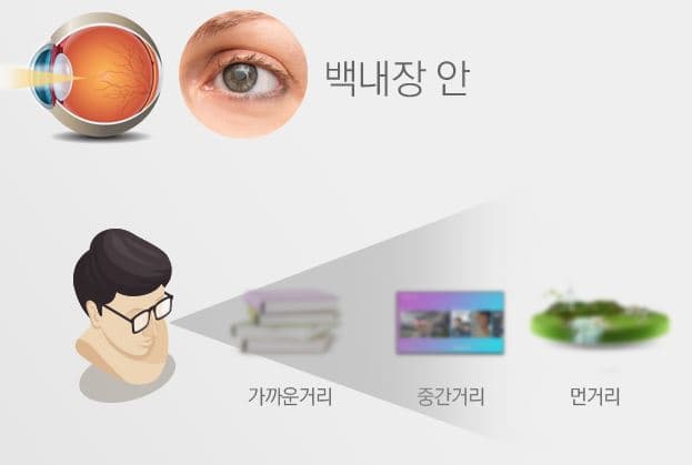 백내장 증상