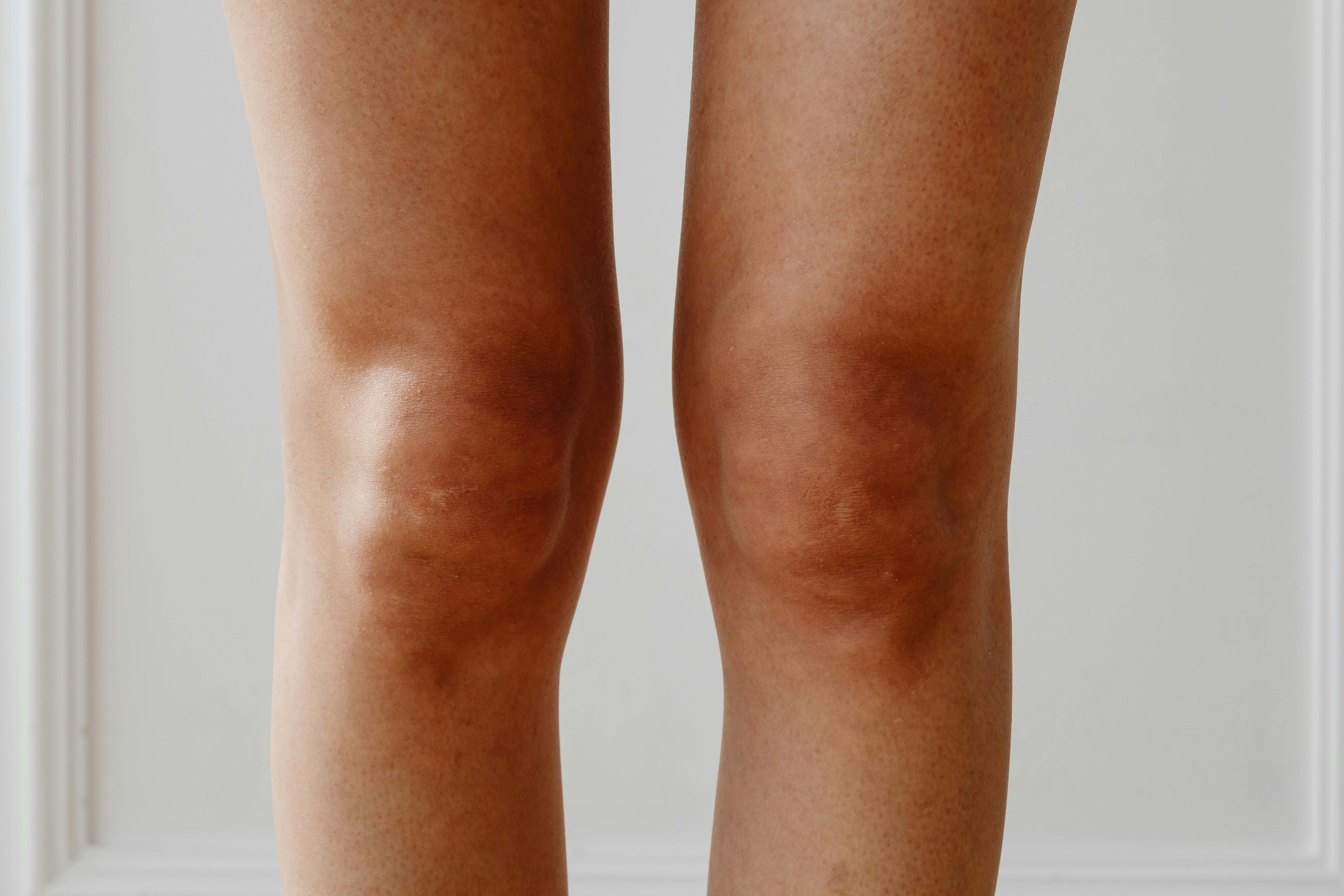산만 다녀오면 무릎이 아픈 이유? 등산 후 통증 원인 8가지
