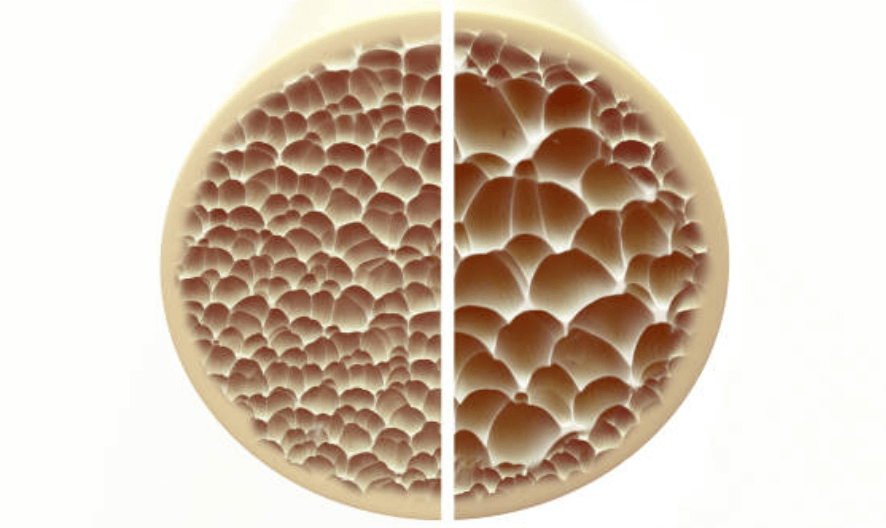 골다공증 검사비용