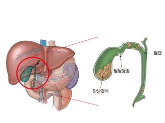 담낭 위치