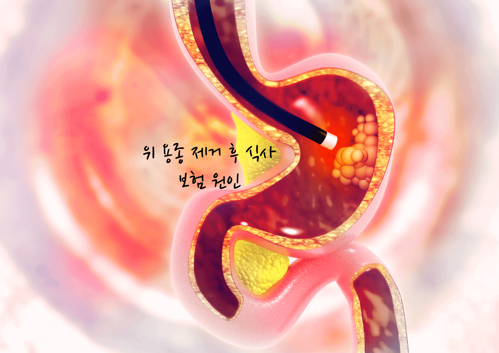 위 용종 제거