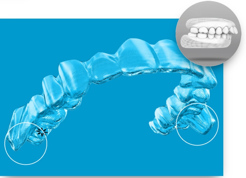 인비절라인, 투명교정, 인비절라인 불편감, 인비절라인 사용감,