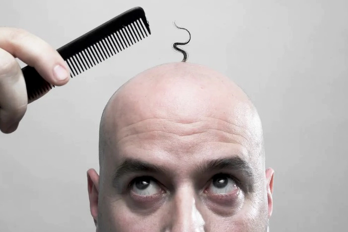 탈모 유전자 검사방법 비용