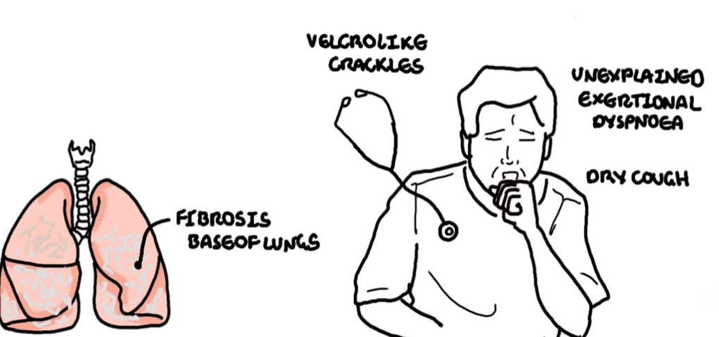 폐 섬유증이란
