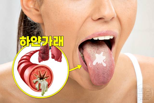 폐 굳는 병 폐섬유증 증상 하얀가래 폐암 전단계 코로나후유증