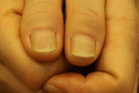 손톱이 잘 부러지는 이유