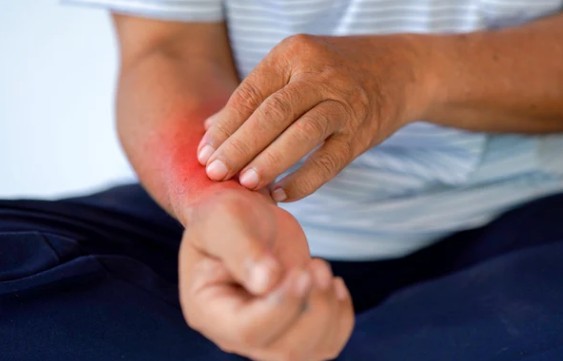 대상포진 초기 증상