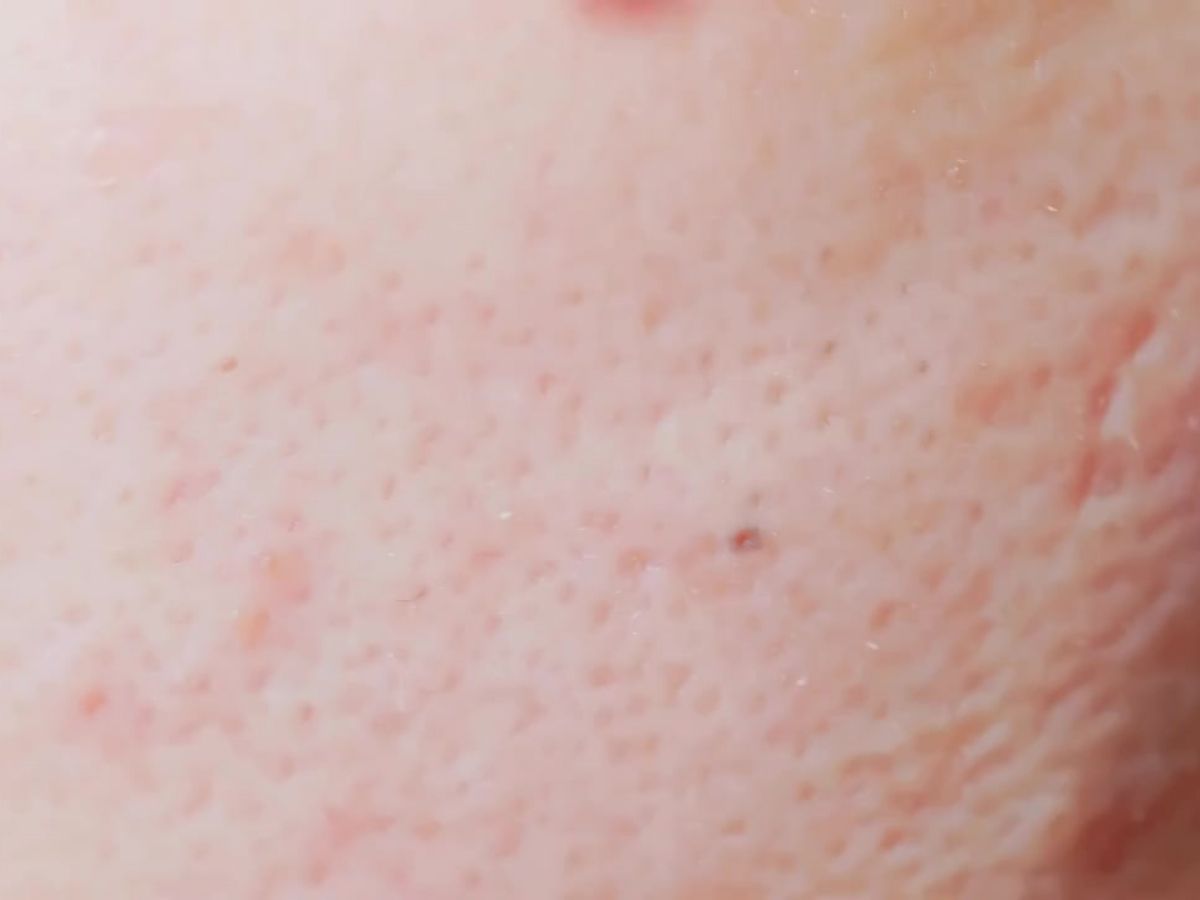 여드름 흉터 연고 추천