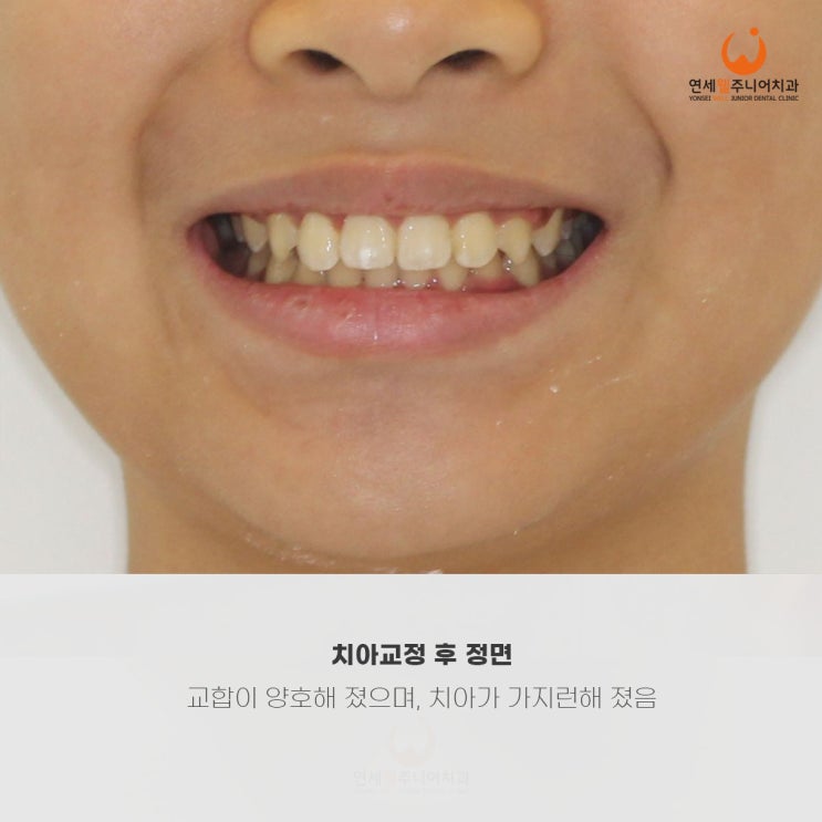 앞니 배열과 위아래 맞물림이 정리된 초등학생 정면 모습