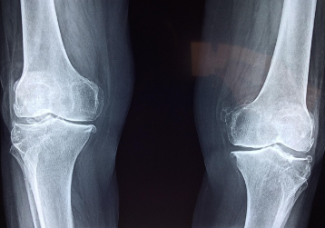 관절 건강을 위한 MSM, 글루코사민, 보스웰리아