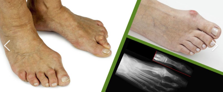 무지외반증과 발가락 통증