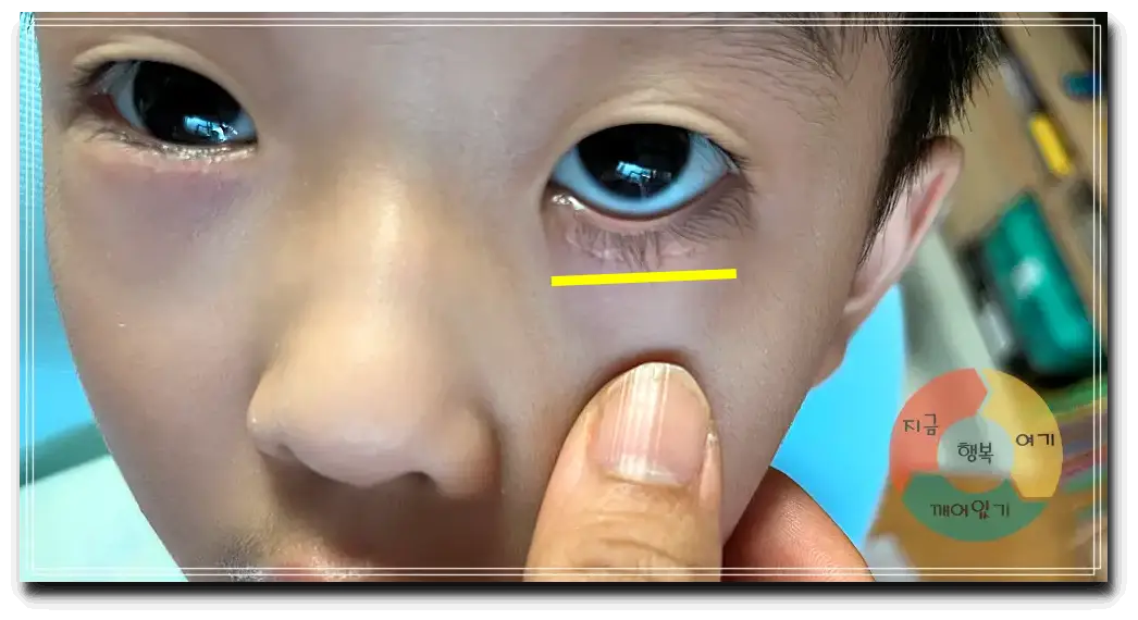 안검내반_수술 경과 6개월 후-눈-밑-흉터