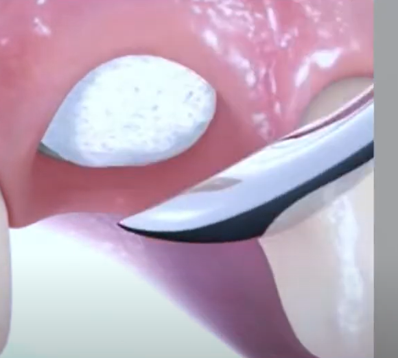 뼈이식이 필요한 경우