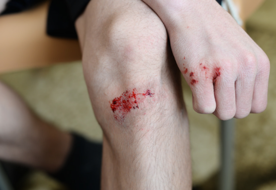 파상풍 초기증상과 원인 예방방법 주사가격 알아보기